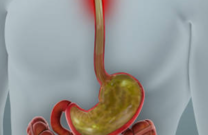 cid reflux and GERD medical illustration.