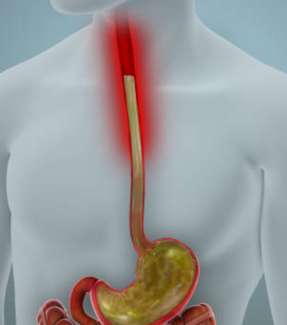Medical illustration of Silent Reflux and GERD mechanism